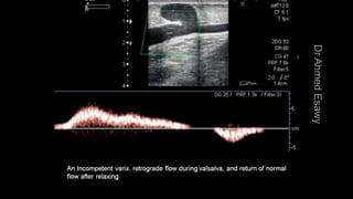 Duplex peripheral veins