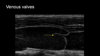 Duplex peripheral veins
