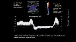 Duplex peripheral veins