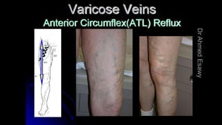 Duplex peripheral veins