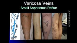 Duplex peripheral veins