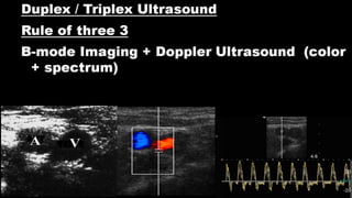 Duplex peripheral veins