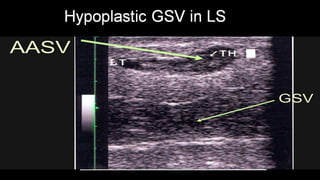 Duplex peripheral veins