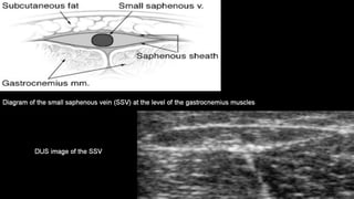 Duplex peripheral veins