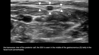 Duplex peripheral veins