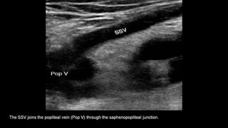 Duplex peripheral veins