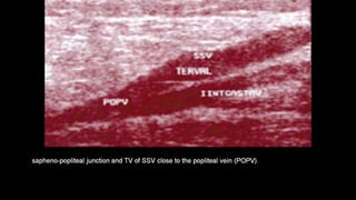 Duplex peripheral veins