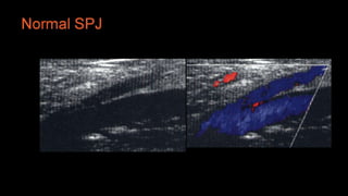 Duplex peripheral veins