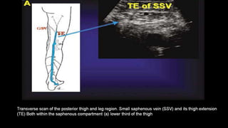 Duplex peripheral veins