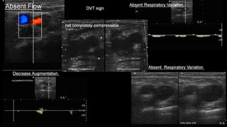 Duplex peripheral veins