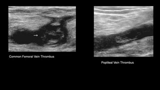 Duplex peripheral veins