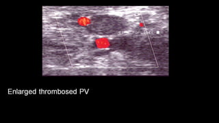 Duplex peripheral veins