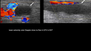 Duplex peripheral veins