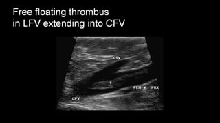 Duplex peripheral veins