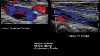 Duplex peripheral veins