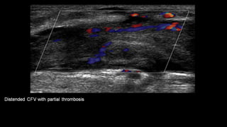 Duplex peripheral veins