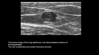 Duplex peripheral veins