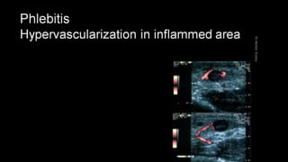 Duplex peripheral veins