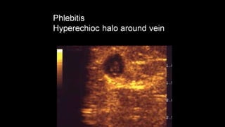 Duplex peripheral veins