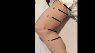 Duplex peripheral veins