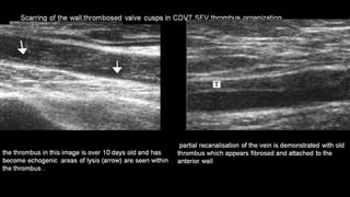 Duplex peripheral veins