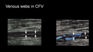 Duplex peripheral veins