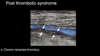Duplex peripheral veins