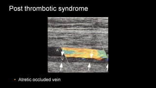 Duplex peripheral veins