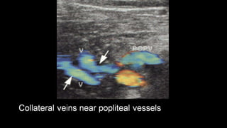 Duplex peripheral veins