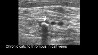 Duplex peripheral veins