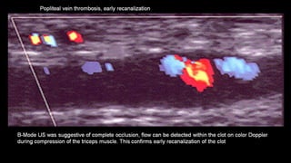 Duplex peripheral veins