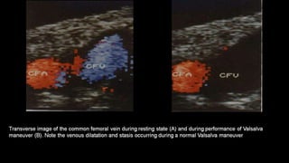 Duplex peripheral veins