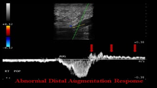 Duplex peripheral veins