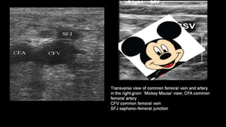 Duplex peripheral veins