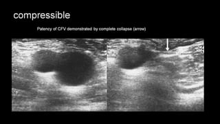 Duplex peripheral veins