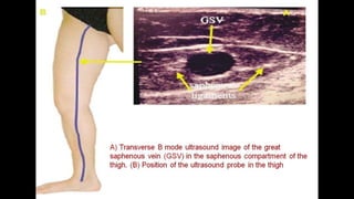 Duplex peripheral veins