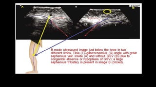 Duplex peripheral veins