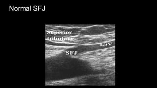 Duplex peripheral veins