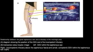 Duplex peripheral veins