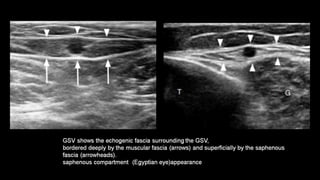Duplex peripheral veins