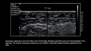 Duplex peripheral veins