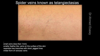 Duplex peripheral veins