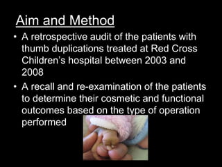 Aim and Method 
• A retrospective audit of the patients with 
thumb duplications treated at Red Cross 
Children’s hospital between 2003 and 
2008 
• A recall and re-examination of the patients 
to determine their cosmetic and functional 
outcomes based on the type of operation 
performed 
 