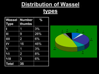 Distribution of Wassel 
types 
Wassel 
Type 
Number 
thumbs 
% 
I 1 3% 
II 9 26% 
III 2 6% 
IV 16 46% 
V 1 3% 
VI 2 8% 
VII 3 6% 
Total 35 
I 
3% 
II 
26% 
III 
8% 
V 
3% 
VI 
6% 
VII 
9% 
IV 
46% 
 