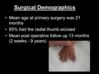 Surgical Demographics 
• Mean age at primary surgery was 21 
months 
• 85% had the radial thumb excised 
• Mean post operative follow up 13 months 
(2 weeks - 9 years) 
 