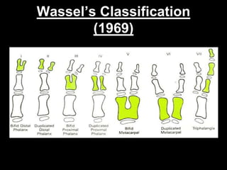 Wassel’s Classification 
(1969) 
 