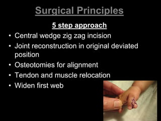 Surgical Principles 
5 step approach 
• Central wedge zig zag incision 
• Joint reconstruction in original deviated 
position 
• Osteotomies for alignment 
• Tendon and muscle relocation 
• Widen first web 
 