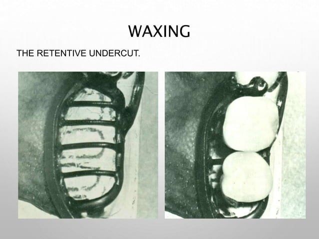 Duplication and wax up in rpd | PPT | Chemistry | Science