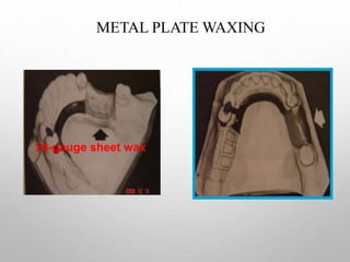 Duplication and wax up in rpd | PPT