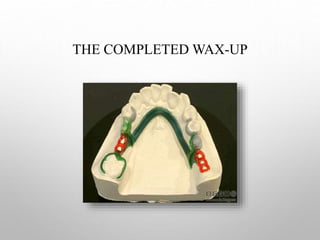 Duplication and wax up in rpd | PPT